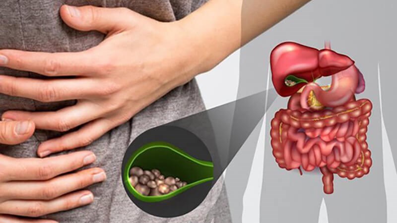 Sỏi mật là một trong những nguyên nhân gây viêm tuỵ cấp