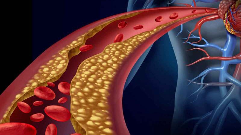 Rối loạn lipid máu được xem là một trong các yếu tố nguy cơ gây viêm tuỵ cấp