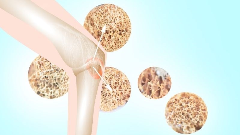 Tiền mãn kinh làm tăng nguy cơ mắc loãng xương