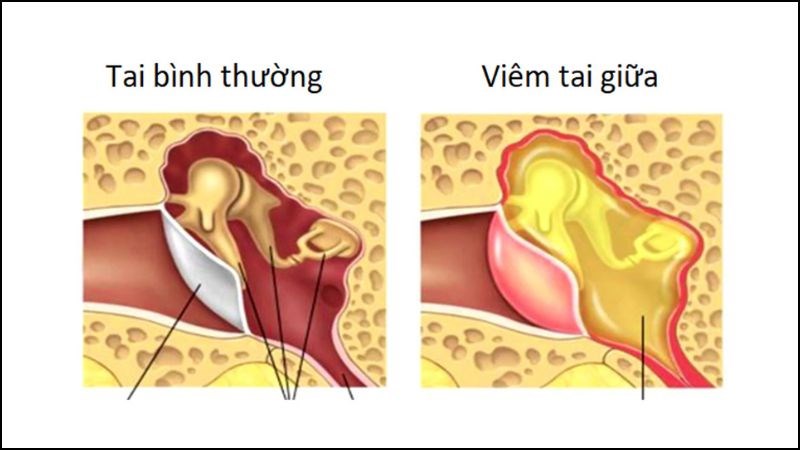 Viêm tai giữa là một trong các nguyên nhân dẫn đến viêm dây thần kinh tiền đình