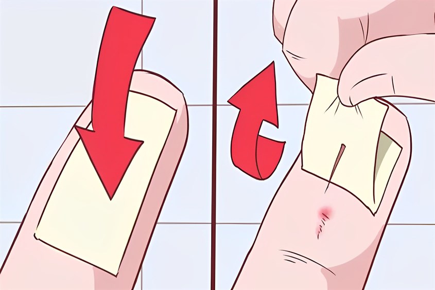 Dùng băng dính là một trong những cách lấy dằm cho bé an toàn