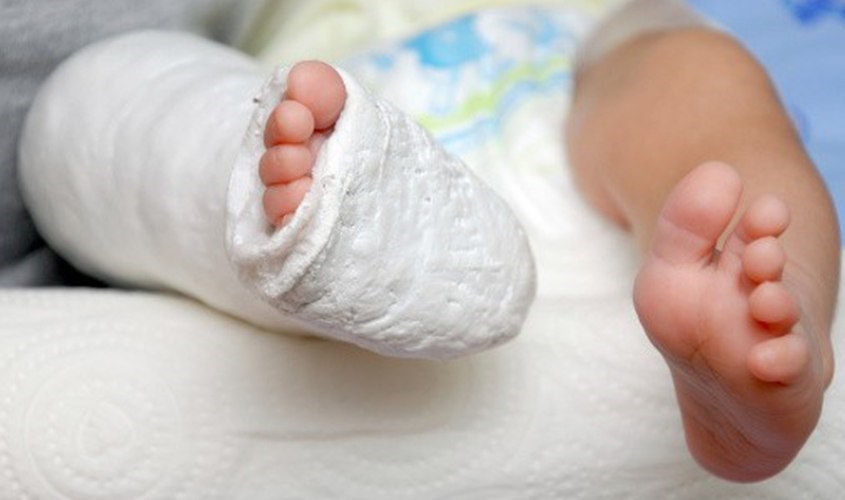 Bó hoặc nẹp chân sẽ giúp cải thiện tình trạng trẻ đi nhón chân Bó hoặc nẹp chân sẽ giúp cải thiện tình trạng trẻ đi nhón chân