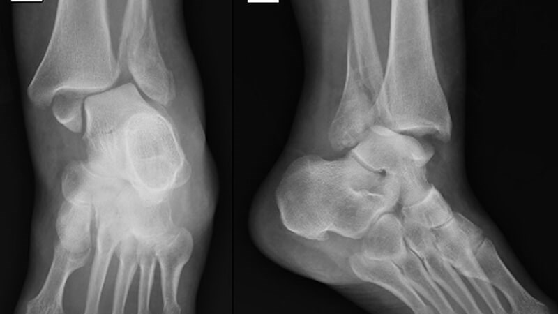 Bác sĩ có thể chỉ định chụp X-quang vùng chấn thương để phân biệt với gãy xương