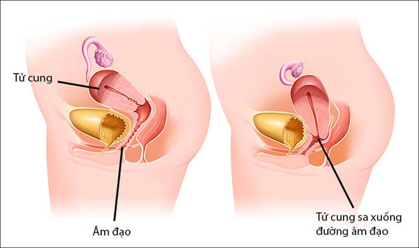 Sa tử cung sau sinh là gì?