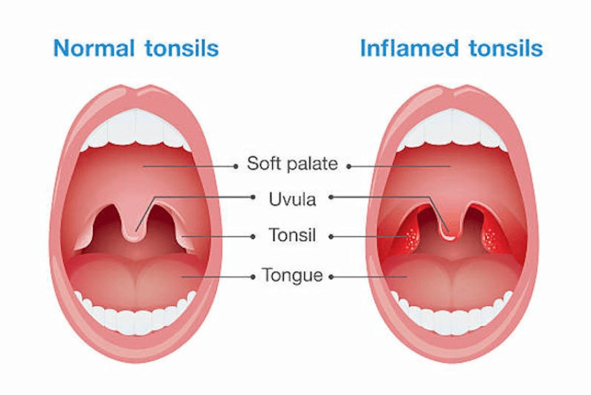 Amidan bị sưng, đỏ Amidan bị sưng, đỏ