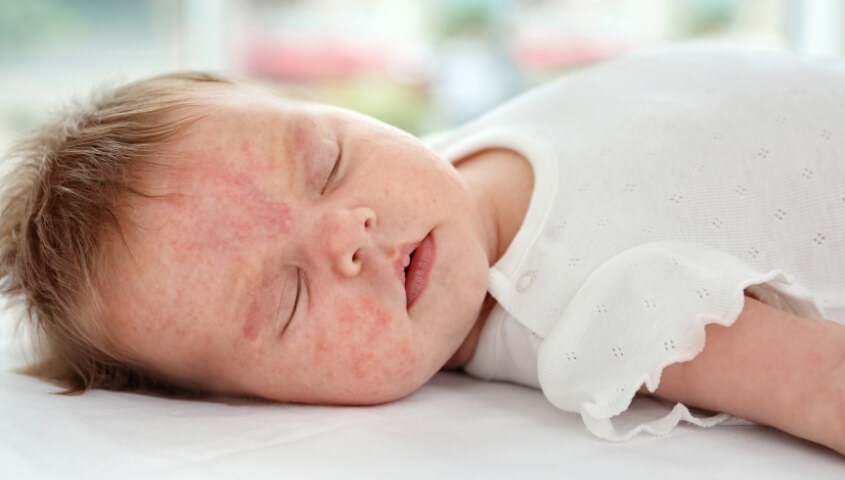 Dấu hiệu rôm sảy ở bé