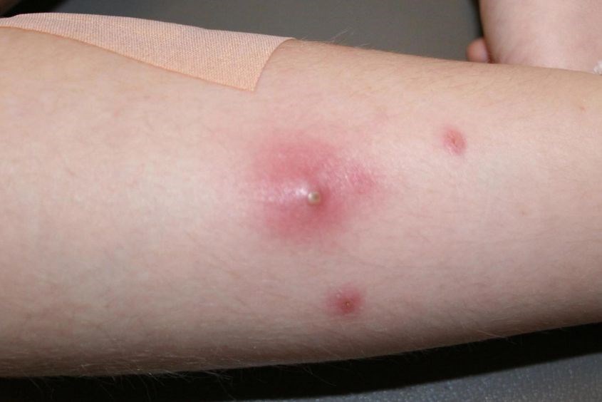 Cách chữa mụn nhọt ở trẻ em hiệu quả nhất Cách chữa mụn nhọt ở trẻ em hiệu quả nhất