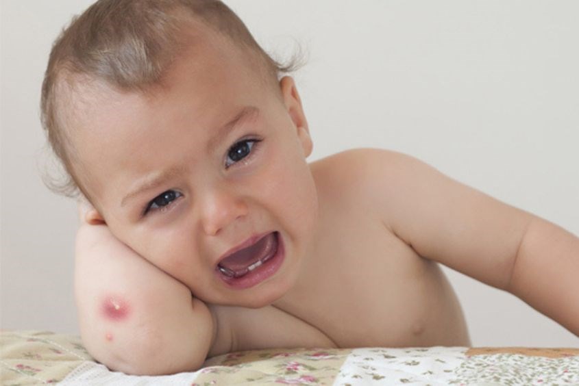 Mụn nhọt ở trẻ em chủ yếu do vi khuẩn gây ra Cách chữa mụn nhọt ở trẻ em an toàn nhất