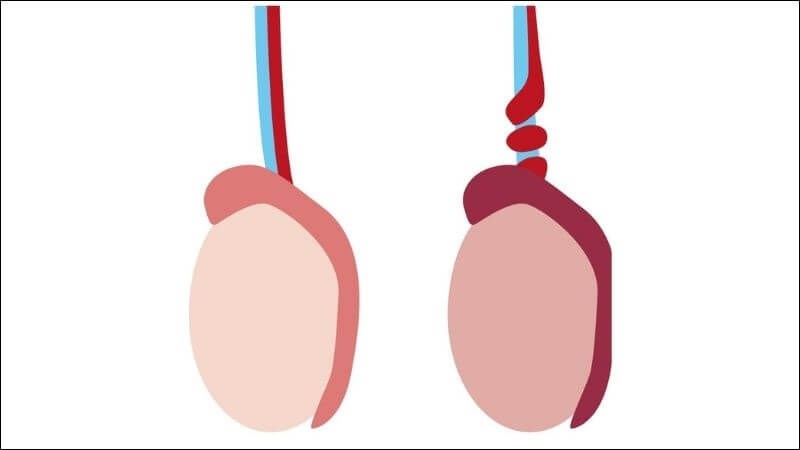 Xoắn tinh hoàn thường xảy ra khi tinh hoàn xoay quá mức sau một va chạm mạnh Xoắn tinh hoàn thường xảy ra khi tinh hoàn xoay quá mức sau một va chạm mạnh
