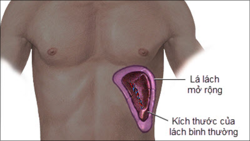 Lách to trong bệnh xơ gan