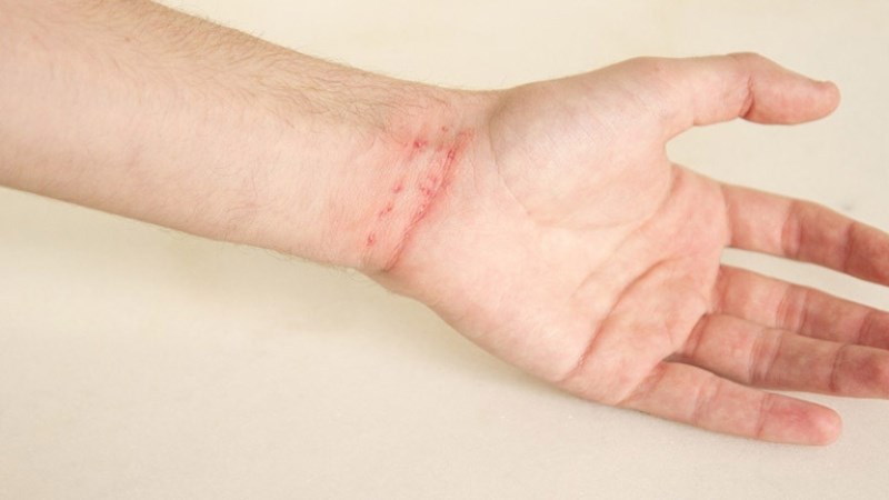 hình ảnh ghẻ ngứa