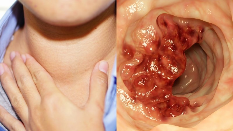 Khối u ở vùng hầu họng, thanh quản và lưỡi cũng là tác nhân gây bệnh viêm họng