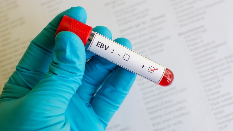 Bệnh tăng bạch cầu đơn nhân nhiễm khuẩn gây ra bởi tác nhân là virus Epstein - Barr