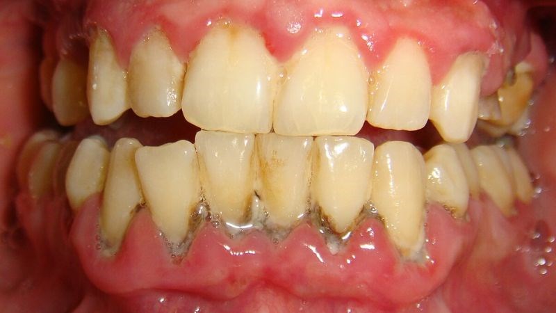 Nướu bị kích ứng dễ gây sưng đau và chảy máu