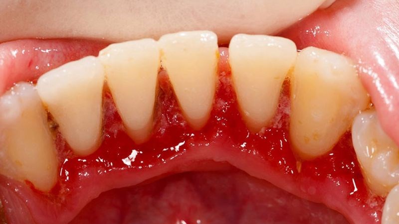 Sưng nướu răng nếu không điều trị có thể dẫn đến mất răng