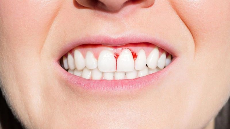 Mảng bám tích tụ lâu ngày dễ gây ảnh hưởng nướu răng