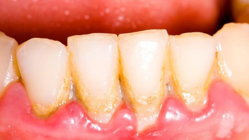 Vệ sinh răng miệng không kỹ dễ gây hôi miệng và viêm nướu