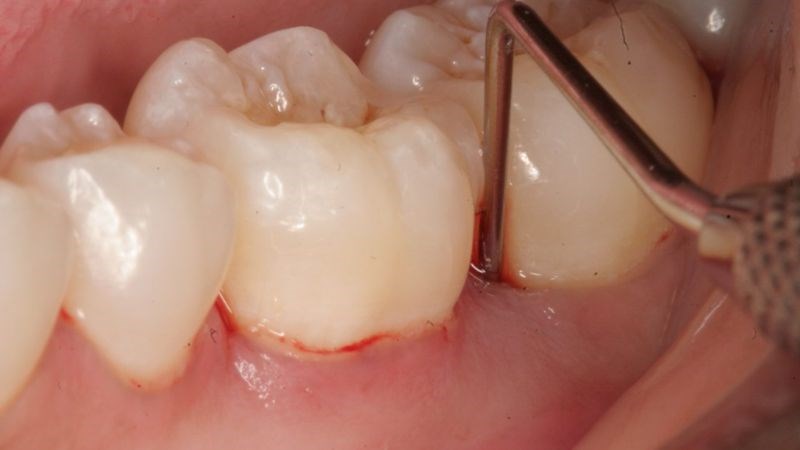 Một số dấu hiệu lỡ miệng, hôi miệng cũng giúp bạn nhận biết sưng nướu răng