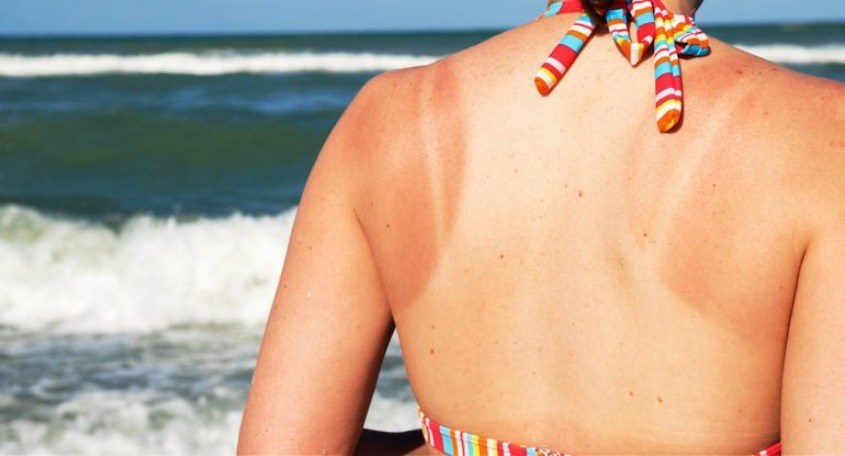 Da bị cháy nắng do ánh mặt trời