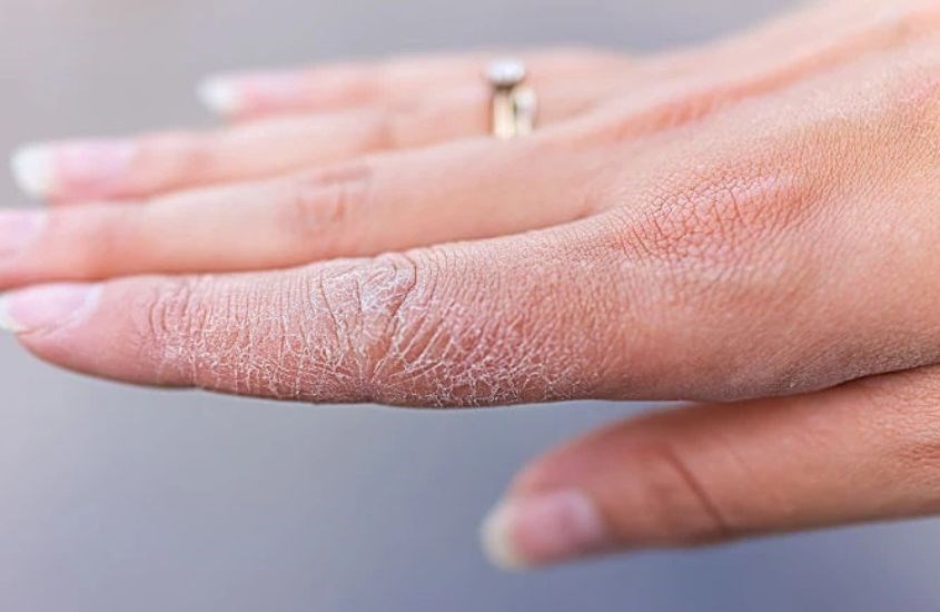 Khi sử dụng quá mức nước rửa tay khô sẽ có thể gây hiện tượng khô căng, nứt nẻ