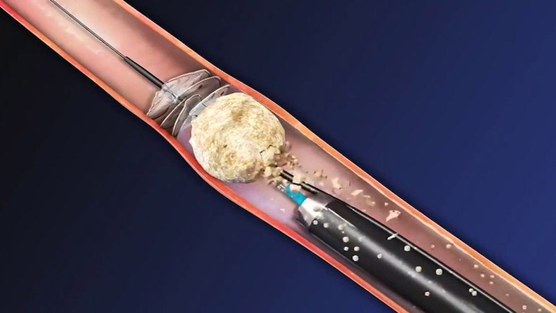 Năng lượng từ laser giúp tán sỏi thành các mảnh nhỏ