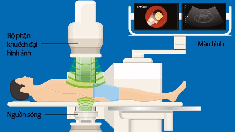 Máy tán sỏi ngoài cơ thể sử dụng sóng xung kích phá vỡ sỏi