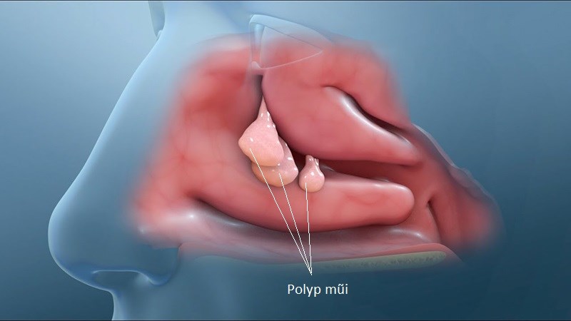 Nguyên nhân ngứa mũi: Tìm hiểu chi tiết và cách phòng ngừa hiệu quả