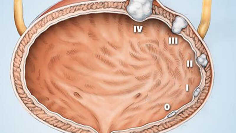 Khối u giai đoạn 3 lan đến lớp mỡ bàng quang