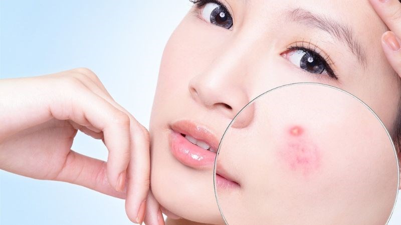 Dùng nước vo gạo để rửa mặt còn có tác dụng chống viêm và trị mụn