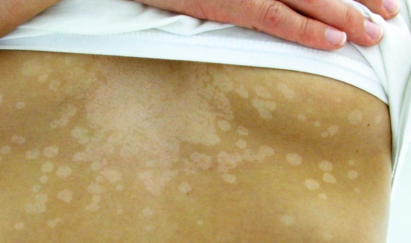 Trẻ bị lang ben sẽ xuất hiện những vết loang khác màu trên da