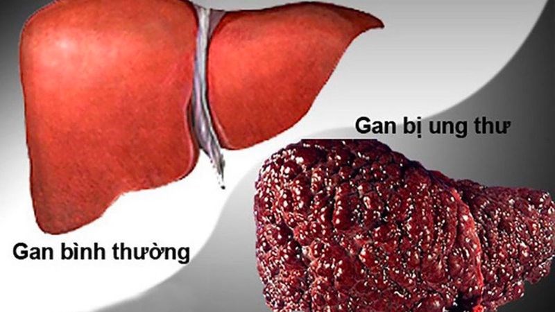 Hiến máu giúp ngăn ngừa nguy cơ mắc ung thư gan