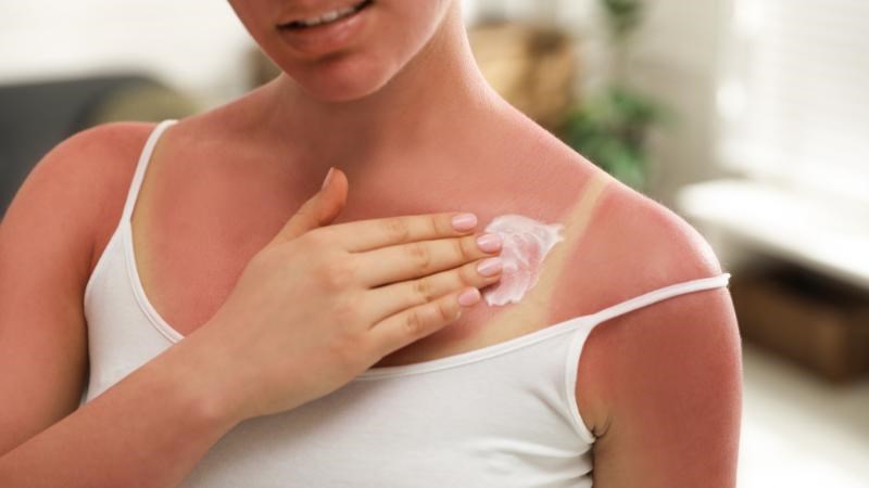 Chú ý chăm sóc vùng da tiếp xúc nhiều với ánh nắng