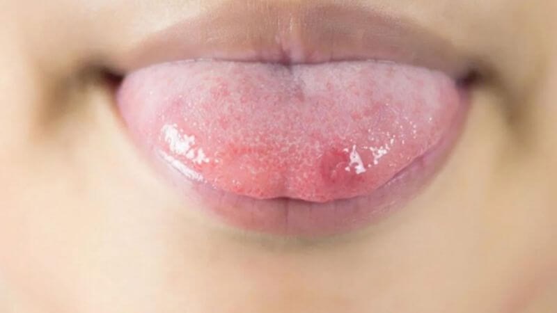 Herpes lưỡi có thể gây ra tình trạng viêm lưỡi