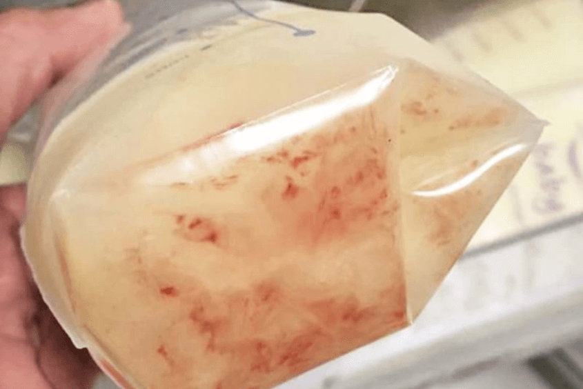 Dấu hiệu có máu trong sữa mẹ