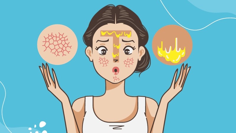 Da hỗn hợp thường gặp da dầu vùng chữ T và da khô ở những vùng còn lại Da hỗn hợp thường gặp da dầu vùng chữ T và da khô ở những vùng còn lại