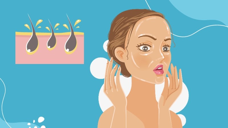 Da dầu là do sự chế tiết dầu quá mức của các tuyến bã nhờn Da dầu là do sự chế tiết dầu quá mức của các tuyến bã nhờn
