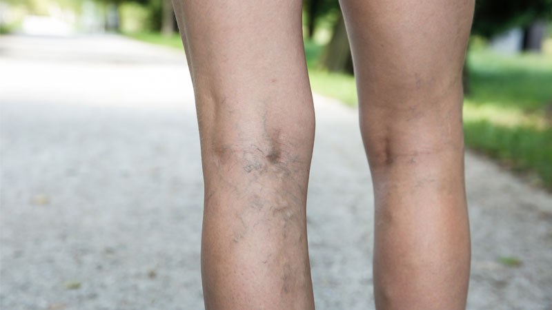 Giãn tĩnh mạch ở chân có thể gây chuột rút