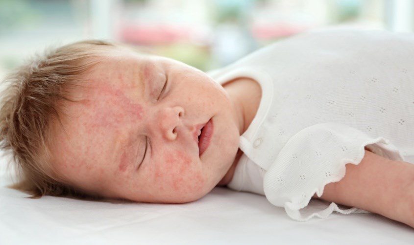 Trẻ bị thiếu DHA có tỷ lệ bị dị ứng cao hơn