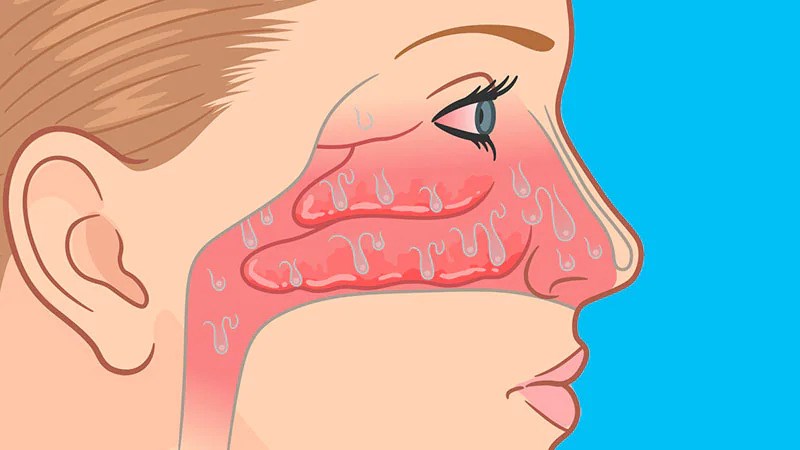 Chất nhầy trong mũi chảy ra gây sổ mũi 