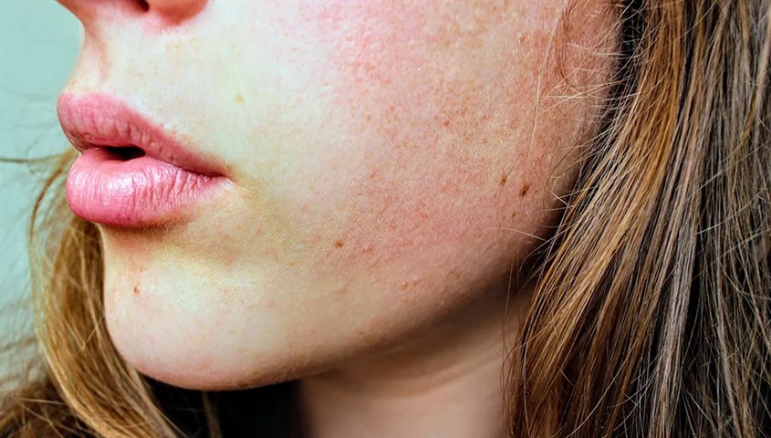 Bị dày sừng quang hoá khiến da Dày sừng quang hoá dễ xuất hiện khi phải ở ngoài trời nhiều