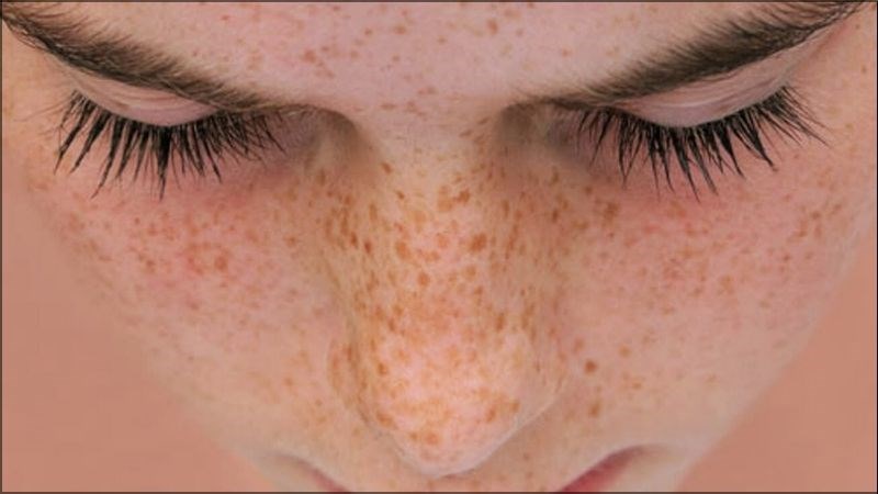 Bệnh nhân khô da sắc tố có nguy cơ cao mắc ung thư da Bệnh nhân khô da sắc tố có nguy cơ cao mắc ung thư da