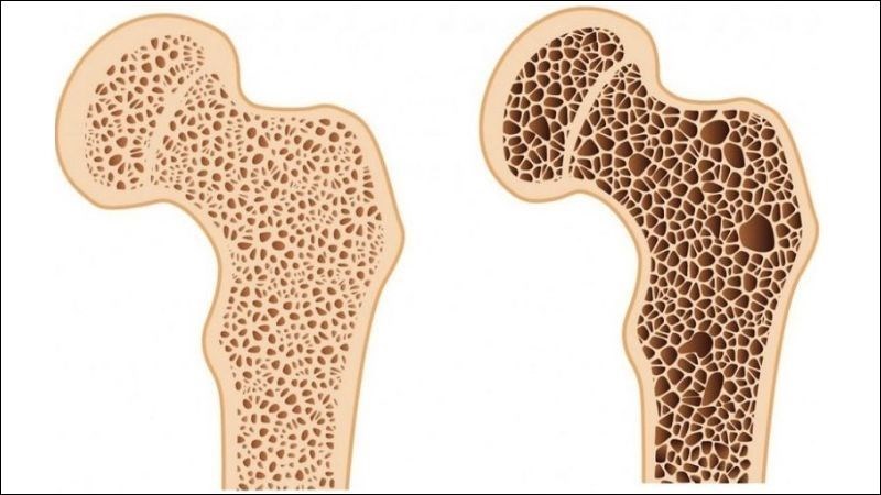 Theo thời gian, việc thiếu hụt canxi có thể gây ra chứng loãng xương