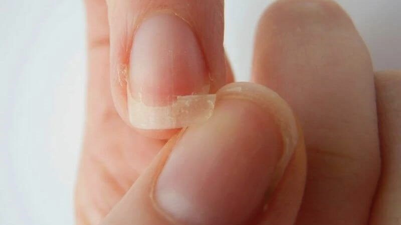 Thiếu hụt canxi làm móng tay giòn, dễ gãy