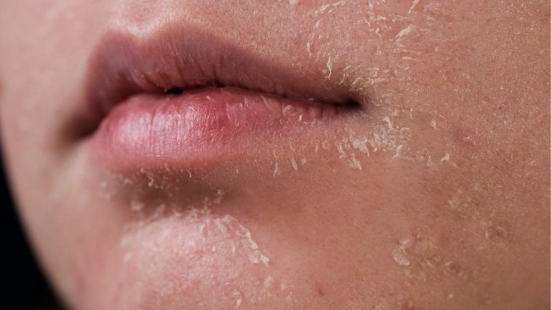 Da khô, bong tróc có thể là dấu hiệu cảnh báo hạ canxi máu