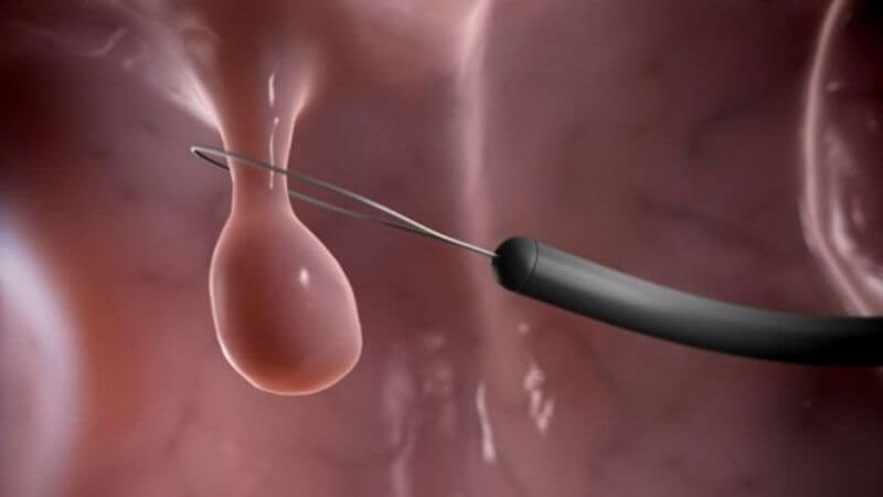 Các nốt thanh âm, u nang và polyp