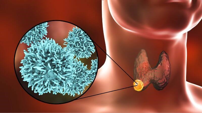 Ung thư tuyến giáp làm liệt dây thanh âm gây khàn tiếng