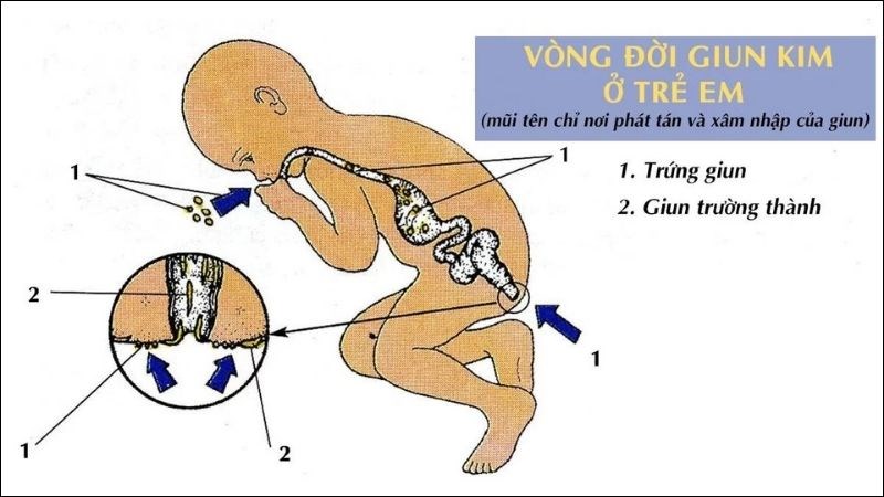 Giun kim xâm nhập vào cơ thể qua đường miệng và thoát ra ngoài qua phân