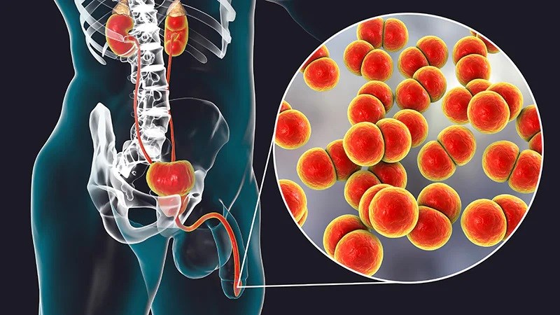 Nhiễm trùng thận có thể gây ra các triệu chứng tiểu ra máu điển hình