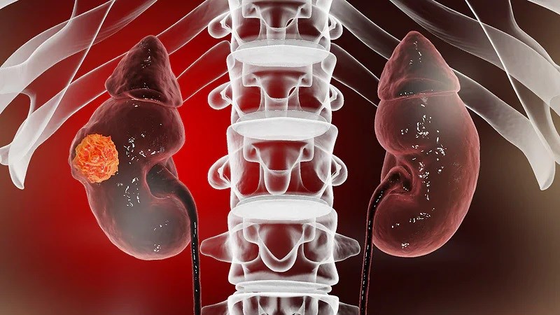 Máu xuất hiện trong nước tiểu có thể gặp trong ung thư