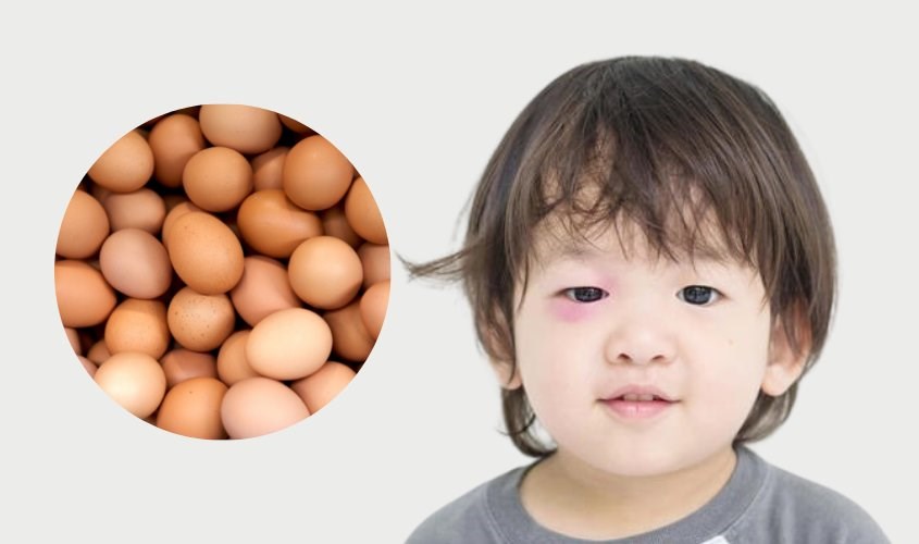 Không sử dụng trứng còn quá nóng để chườm lên mắt của trẻ